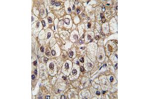 Formalin-fixed and paraffin-embedded human hepatocarcinoma tissue reacted with CYP2C9 antibody (Center), which was peroxidase-conjugated to the secondary antibody, followed by DAB staining. (CYP2C9 抗体  (AA 235-265))