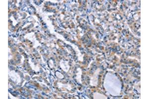 The image on the left is immunohistochemistry of paraffin-embedded Human thyroid cancer tissue using (LRRK2 Antibody) at dilution 1/20, on the right is treated with fusion protein. (LRRK2 抗体)