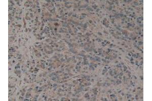 IHC-P analysis of Human Prostate Gland Cancer Tissue, with DAB staining. (CALU 抗体  (AA 20-315))