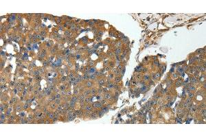 Immunohistochemistry of paraffin-embedded Human breast cancer using MSN Polyclonal Antibody at dilution of 1:30 (Moesin 抗体)