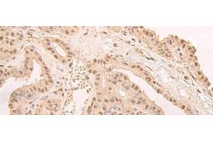 Immunohistochemistry of paraffin-embedded Human thyroid cancer tissue using CNOT10 Polyclonal Antibody at dilution of 1:50(x200) (CNOT10 抗体)