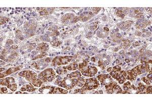 ABIN6272371 at 1/100 staining Human liver cancer tissue by IHC-P. (OR2C3 抗体)