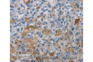 Immunohistochemistry of Human liver cancer using DNAJB4 Polyclonal Antibody at dilution of 1:50 (DNAJB4 抗体)