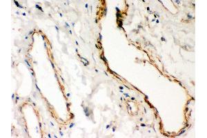 Anti- Dystrophin Picoband antibody, IHC(P) IHC(P): Human Lung Cancer Tissue (Dystrophin 抗体  (AA 3076-3404))