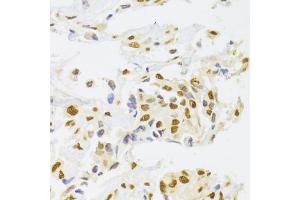 Immunohistochemistry of paraffin-embedded human breast cancer using HNRNPA1 Antibody (ABIN5975570) at dilution of 1/100 (40x lens). (HNRNPA1 抗体)