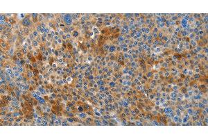 Immunohistochemistry of paraffin-embedded Human liver cancer tissue using HTRA3 Polyclonal Antibody at dilution 1:45 (HTRA3 抗体)