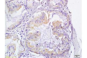 Formalin-fixed and paraffin embedded human gastric cancer  labeled with Anti-VEGFR3 Polyclonal Antibody, unconjugated  (ABIN678578) at 1: 200 followed by incubation with conjugated secondary antibody and DAB staining (FLT4 抗体  (AA 901-1000))