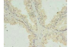 Immunohistochemistry of paraffin-embedded human prostate cancer using ABIN7156699 at dilution of 1:100 (PRKRA 抗体  (AA 1-313))