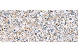 Immunohistochemistry of paraffin-embedded Human liver cancer tissue using MTHFD2 Polyclonal Antibody at dilution of 1:65(x200) (MTHFD2 抗体)