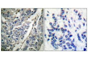 Immunohistochemical analysis of paraffin-embedded human breast carcinoma tissue using Synaptotagmin (phospho-Thr202) antibody (left)or the same antibody preincubated with blocking peptide (right). (SYT1 抗体  (pThr202))