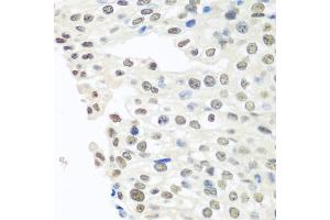 Immunohistochemistry of paraffin-embedded human prostate cancer using TARDBP antibody. (TARDBP 抗体)