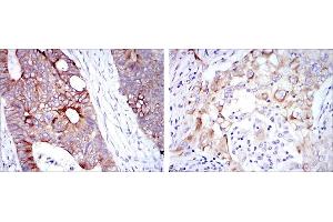 Immunohistochemical analysis of paraffin-embedded rectum cancer tissues (left) and lung cancer tissues (right) using KRT19 mouse mAb with DAB staining. (Cytokeratin 19 抗体)