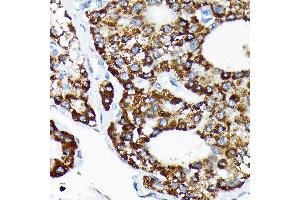 Immunohistochemistry of paraffin-embedded human liver cancer using HSP Rabbit mAb (ABIN7267580) at dilution of 1:100 (40x lens). (HSPA4 抗体)