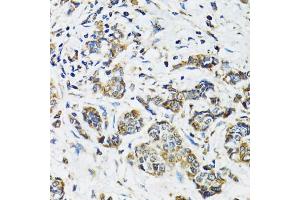 Immunohistochemistry of paraffin-embedded human breast cancer using SSBP1 antibody (ABIN5974202) at dilution of 1/100 (40x lens). (SSBP1 抗体)