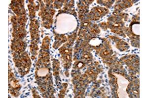 The image on the left is immunohistochemistry of paraffin-embedded Human thyroid cancer tissue using ABIN7130808(RAMP1 Antibody) at dilution 1/10, on the right is treated with fusion protein. (RAMP1 抗体)