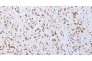 Immunohistochemistry of paraffin-embedded Human esophagus cancer tissue using MCM2 Polyclonal Antibody at dilution 1:50 (MCM2 抗体)