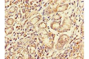 Immunohistochemistry of paraffin-embedded human gastric cancer using ABIN7158537 at dilution of 1:100 (FCGR2A 抗体  (AA 241-317))