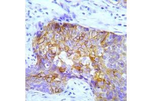 Immunohistochemical analysis of paraffin-embedded human lung adenocarcinoma tissue using Crk2 (Phospho-Try221) Antibody (E012070). (CDK6 抗体  (pTry221))