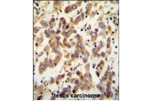 C antibody (Center) (ABIN654782 and ABIN2844463) immunohistochemistry analysis in formalin fixed and paraffin embedded human testis carcinoma followed by peroxidase conjugation of the secondary antibody and DAB staining. (C20ORF173 抗体  (AA 48-76))