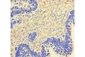 Immunohistochemistry of paraffin-embedded human ovarian cancer using ABIN7154402 at dilution of 1:100 (GM-CSF 抗体  (AA 18-144))