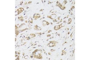 Immunohistochemistry of paraffin-embedded human gastric cancer using DMAP1 antibody (ABIN6003515) at dilution of 1/100 (40x lens). (DMAP1 抗体)