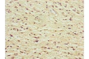 Immunohistochemistry of paraffin-embedded human glioma using ABIN7165859 at dilution of 1:100 (NEDD1 抗体  (AA 411-660))
