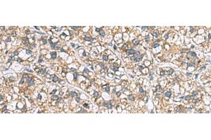 Immunohistochemistry of paraffin-embedded Human liver cancer tissue using MRPL22 Polyclonal Antibody at dilution of 1:60(x200) (MRPL22 抗体)