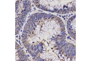 Immunohistochemistry of paraffin-embedded human rectal cancer using NPPA antibody.