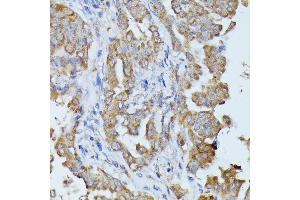 Immunohistochemistry of paraffin-embedded human thyroid cancer using HAL antibody (ABIN6130467, ABIN6141593, ABIN6141594 and ABIN6216851) at dilution of 1:100 (40x lens). (HAL 抗体  (AA 1-200))
