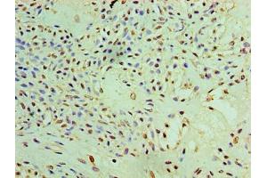 Immunohistochemistry of paraffin-embedded human breast cancer using ABIN7166888 at dilution of 1:100 (PYCR1 抗体  (AA 2-319))