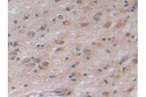 IHC-P analysis of Human Glioma Tissue, with DAB staining. (NOTCH4 抗体  (AA 1715-2001))