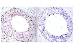 Immunohistochemical analysis of paraffin-embedded human breast carcinoma tissue using NFkB-p65(Phospho-Thr254) Antibody(left) or the same antibody preincubated with blocking peptide(right). (NF-kB p65 抗体  (pThr254))
