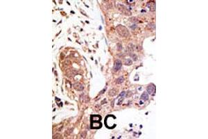 Formalin-fixed and paraffin-embedded human cancer tissue reacted with the SENP1 polyclonal antibody  , which was peroxidase-conjugated to the secondary antibody, followed by AEC staining. (SENP1 抗体  (N-Term))