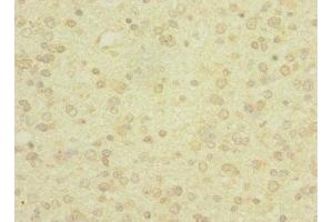 Immunohistochemistry of paraffin-embedded human glioma using ABIN7166564 at dilution of 1:100 (PCDH19 抗体  (AA 568-678))