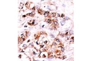 Formalin-fixed and paraffin-embedded human cancer tissue reacted with the primary antibody, which was peroxidase-conjugated to the secondary antibody, followed by AEC staining. (DUSP15 抗体  (N-Term))