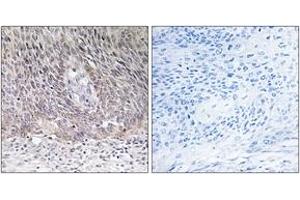 Immunohistochemistry analysis of paraffin-embedded human cervix carcinoma tissue, using ARSA Antibody. (Arylsulfatase A 抗体  (AA 251-300))