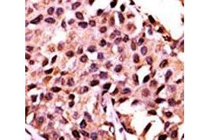 IHC analysis of FFPE human breast carcinoma stained with the PPP3CC antibody