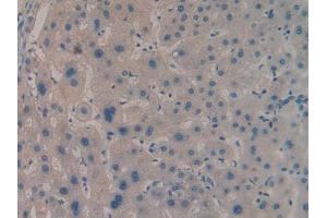 IHC-P analysis of Human Liver cancer Tissue, with DAB staining. (IGF2BP2 抗体  (AA 141-384))