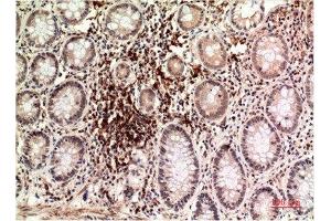 Immunohistochemical analysis of paraffin-embedded Human Colon Carcinoma Tissue using Epsilon Tubulin Mouse mAb diluted at 1:200. (TUBE1 抗体)