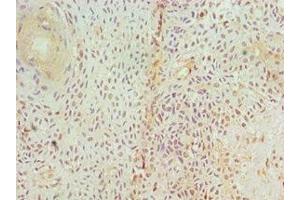 Immunohistochemistry of paraffin-embedded human breast cancer using ABIN7153952 at dilution of 1:100 (GAD 抗体  (AA 1-200))