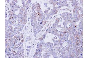 IHC-P Image Immunohistochemical analysis of paraffin-embedded OVCAR3 xenograft , using Desmocollin 2 , antibody at 1:500 dilution. (Desmocollin 2 抗体)