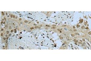 Immunohistochemistry of paraffin-embedded Human esophagus cancer tissue using WDR4 Polyclonal Antibody at dilution of 1:40(x200) (WDR4 抗体)