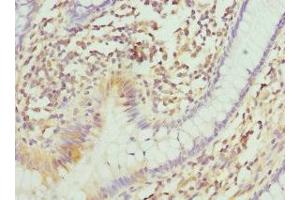 Immunohistochemistry of paraffin-embedded human colon cancer using ABIN7147369 at dilution of 1:100 (ITGB3BP 抗体  (AA 1-177))