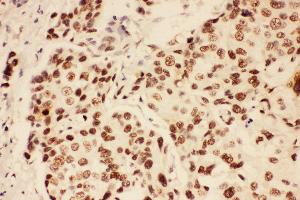 Anti-BRCA1 Picoband antibody,  IHC(P): Human Mammary Cancer Tissue (BRCA1 抗体  (AA 1661-1863))