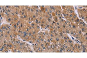 Immunohistochemistry of paraffin-embedded Human liver cancer using Cyclophilin F Polyclonal Antibody at dilution of 1:45 (PPIF 抗体)