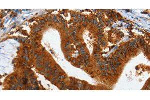 Immunohistochemistry of paraffin-embedded Human colon cancer tissue using IL20RA Polyclonal Antibody at dilution 1:35 (IL20RA 抗体)