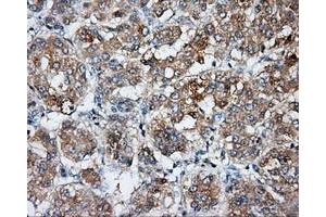 Immunohistochemical staining of paraffin-embedded Carcinoma of liver tissue using anti-BSG mouse monoclonal antibody. (CD147 抗体)