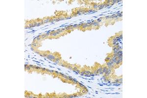 Immunohistochemistry of paraffin-embedded human prostate using KLK11 antibody (ABIN6129403, ABIN6142946, ABIN6142948 and ABIN6216242) at dilution of 1:100 (40x lens). (Kallikrein 11 抗体  (AA 1-250))