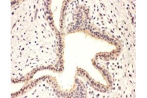 IHC-P: Rab8 antibody testing of human breast cancer tissue (RAB8A 抗体  (C-Term))
