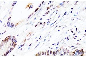 Immunohistochemistry of paraffin-embedded Human colon carcinoma using FGF12 Polyclonal Antibody at dilution of 1:150 (40x lens). (FGF12 抗体)
